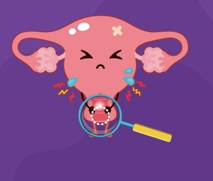 what is Endometriosis