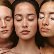 Skin Products For Acne Treatments