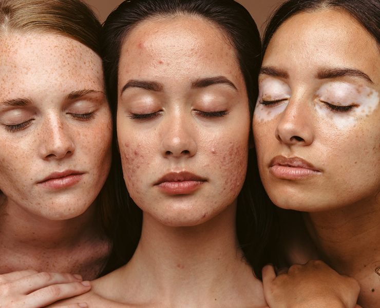 Skin Products For Acne Treatments