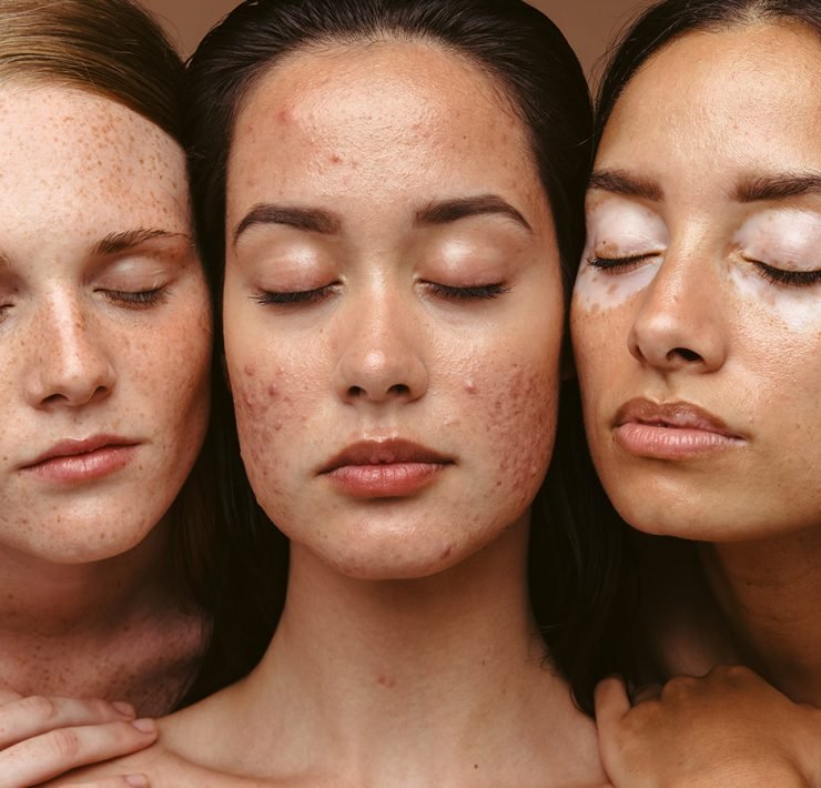 Skin Products For Acne Treatments