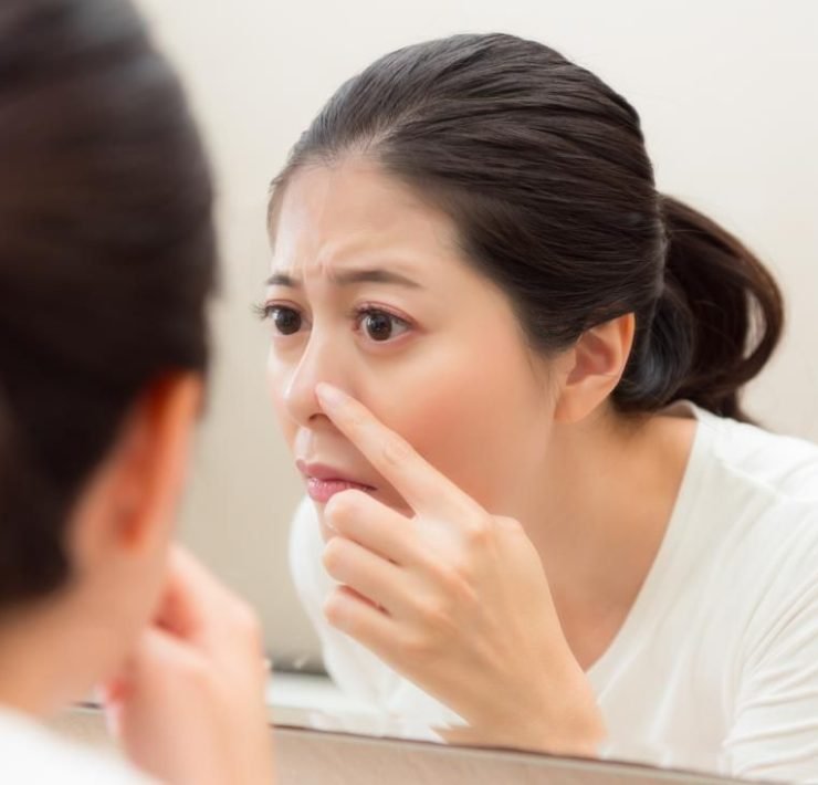 how to remove blackheads