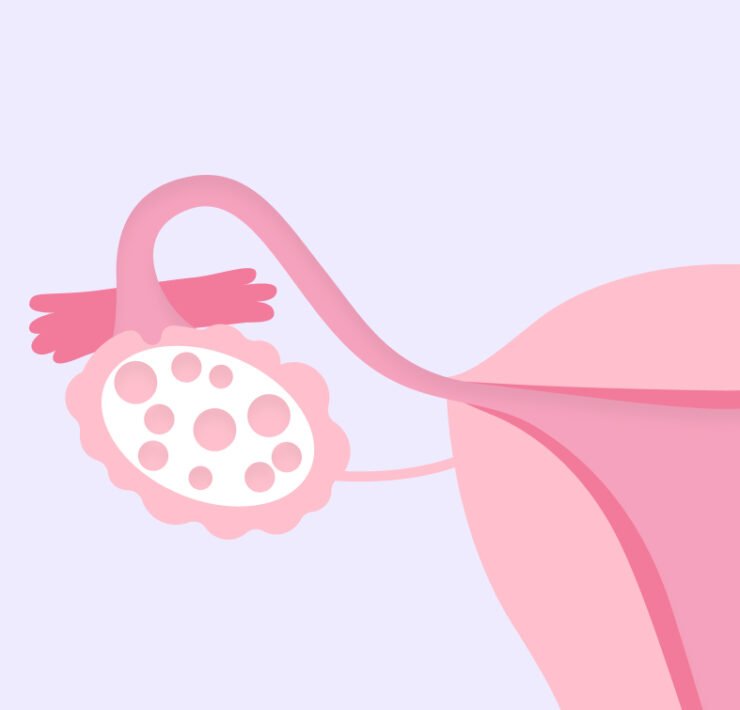 pcos symptoms