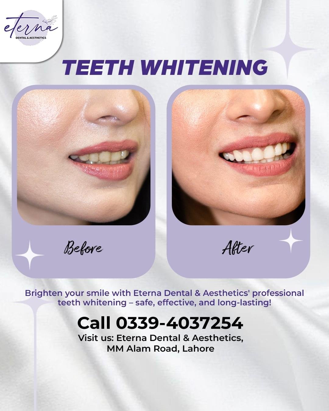 teeth whitening