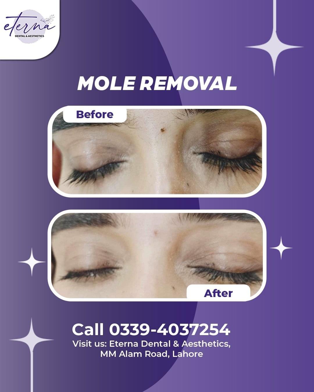 mole removal